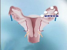 输卵管妊娠的图片