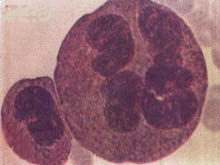 松果体瘤的图片
