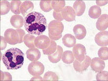 特发性高嗜酸性细胞综合征的图片