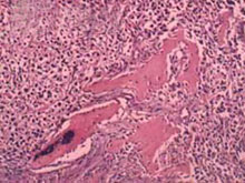 透明细胞软骨肉瘤的图片