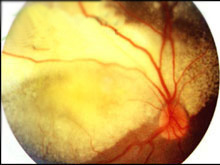 外层渗出性视网膜病变的图片
