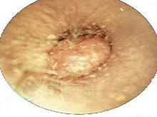 外耳道乳头状瘤的图片