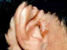 外耳湿疹的图片
