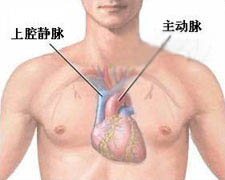 完全性肺静脉异位回流的图片