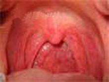 萎缩性咽炎的图片