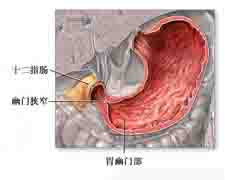 胃平滑肌肉瘤的图片