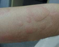 荨麻疹和血管性水肿的图片