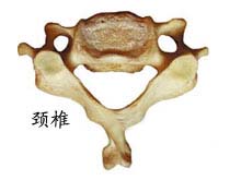先天性颈椎齿状突畸形的图片
