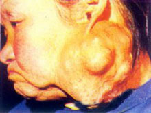 涎腺混合瘤的图片