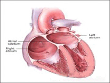 限制型心脏病的图片
