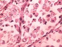 腺泡状软组织肉瘤的图片