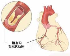心血管和血栓栓塞综合征的图片