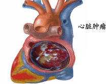 心脏内粘液瘤的图片