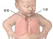 新生儿肺炎的图片