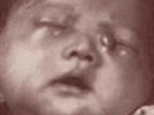 新生儿泪囊炎的图片