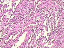 血管肉瘤的图片