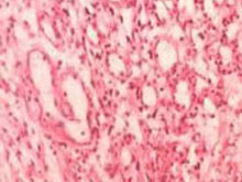 血管网织细胞瘤的图片
