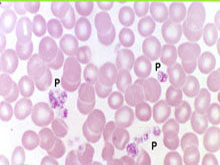血栓性血小板减少性紫癜的图片