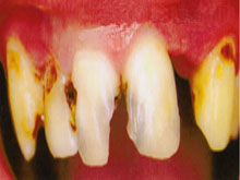 牙体缺损的图片