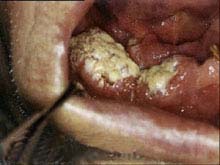 牙龈癌的图片