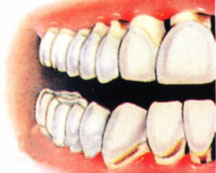 牙周病的图片