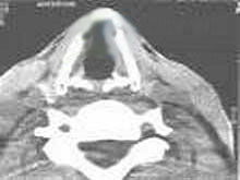 咽部乳头状瘤的图片