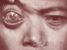 眼眶假瘤的图片