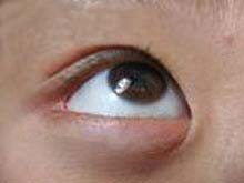 眼酸硷化学伤的图片