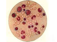 遗传性出血性毛细血管扩张症的图片