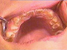 遗传性乳光牙的图片