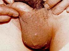 阴囊湿疹的图片