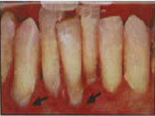 单纯性牙周炎的图片