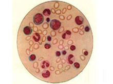 营养性巨幼红细胞性贫血的图片