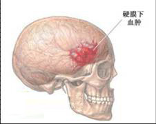 硬脑膜下血肿的图片