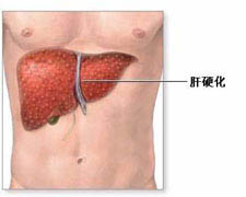 原发性肝内硬化综合征的图片