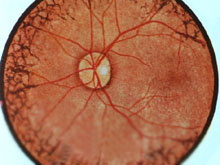 原发性视网膜色素变性的图片