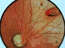 原发性视网膜脱离的图片