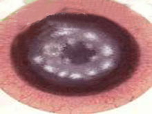 真菌性角膜炎的图片