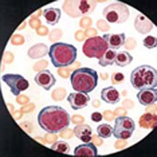 阵发性睡眠性血红蛋白尿的图片