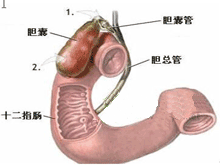 胆囊管综合征的图片