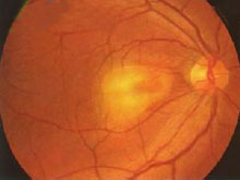 中心性浆液性脉络膜视网膜病变的图片