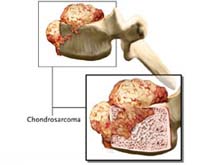 中心性软骨肉瘤的图片