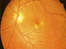 中心性渗出性脉络膜视网膜炎的图片