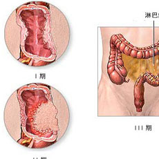 肿瘤性息肉的图片