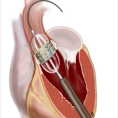 主动脉瓣膜部狭窄的图片