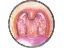 白血病性咽峡炎的图片