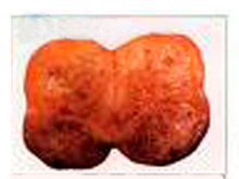 多发性内分泌肿瘤综合征Ⅰ型的图片