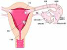 多囊卵巢综合征的图片