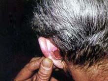 耳部恶性肿瘤的图片