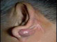 耳后骨膜下脓肿的图片